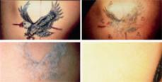 Before and after tattoo removal photos