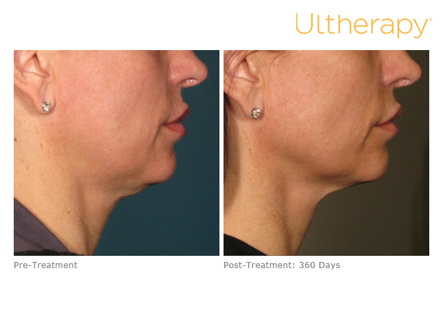 Before and after Ultherapy treatments