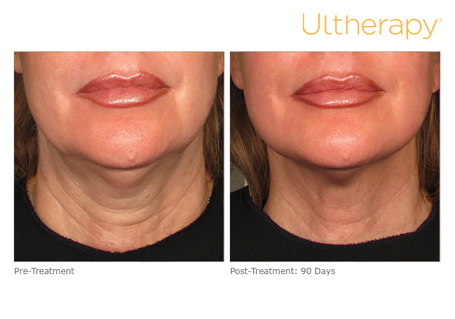 Before and after Ultherapy treatments