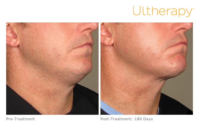 Before and after Ultherapy treatments