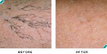 Before and after vein treatments