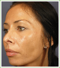 After a chemical peel photo