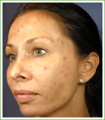 Before a chemical peel