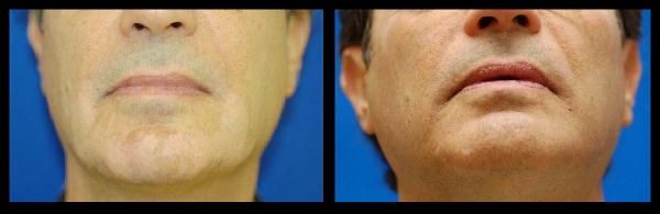 Before and after Excimer laser treatments