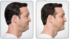 Before and after Kybella treatments for men