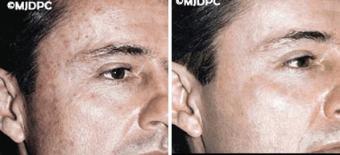 Before and after PhotoFacial treatments for men