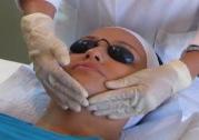 Chemical peels for men