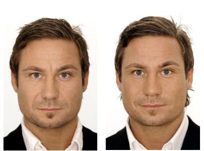 Before and after Restylane treatments for men