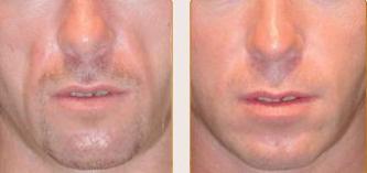 Before and after Sculptra treatments