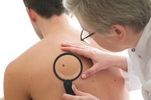 Moles and Lesions