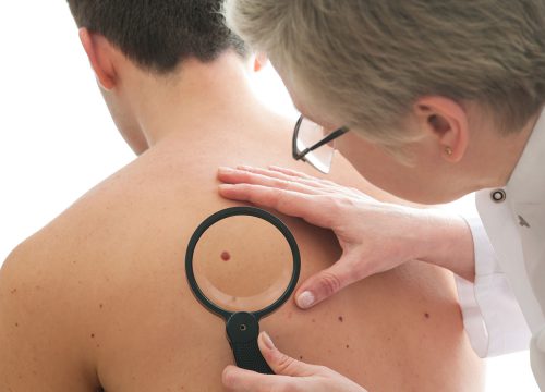 Moles and Lesions
