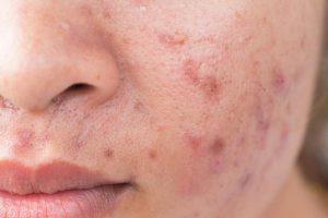 Acne Scars