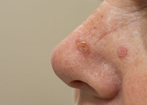 Actinic Keratosis