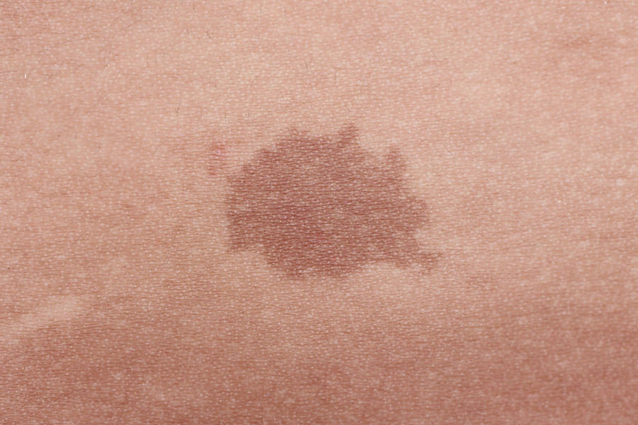 Birthmarks | Dermatology and Laser Centre of Los Angeles