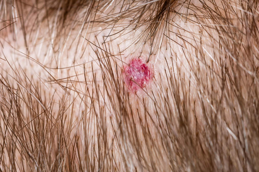 Sebaceous Hyperplasia Dermatology And Laser Centre Of Los Angeles Sebaceous Hyperplasia Dermatology And Laser Centre Of Los Angeles