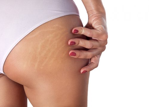 Laser Reduction for Stretch Marks