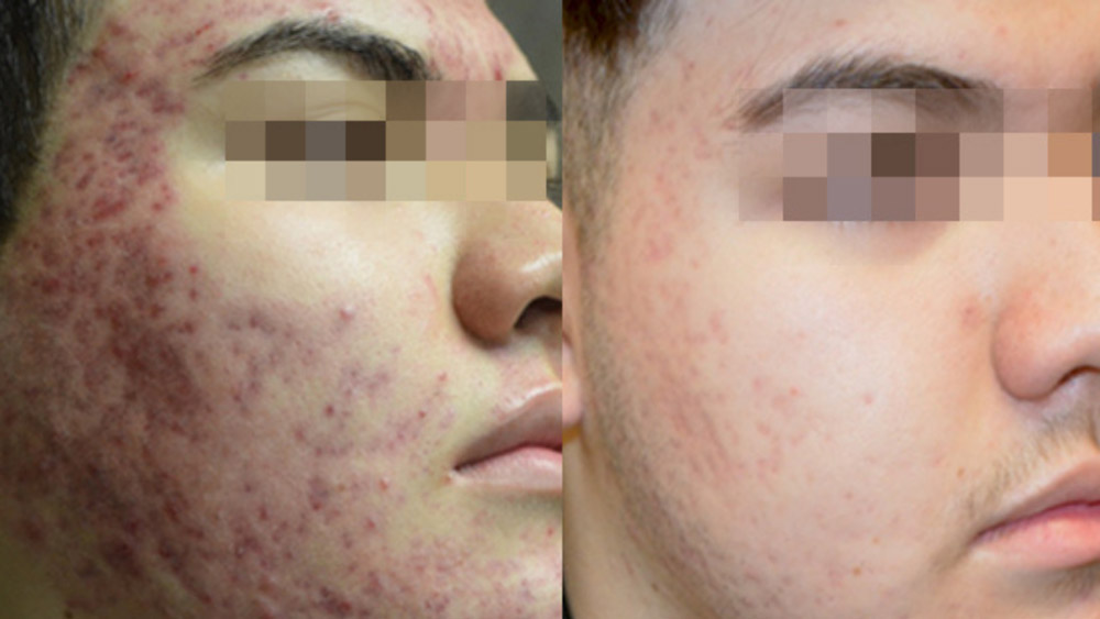 Before and after acne treatment results
