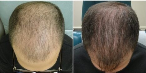 hair restoration for men