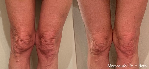 Morpheus8 leg treatment results