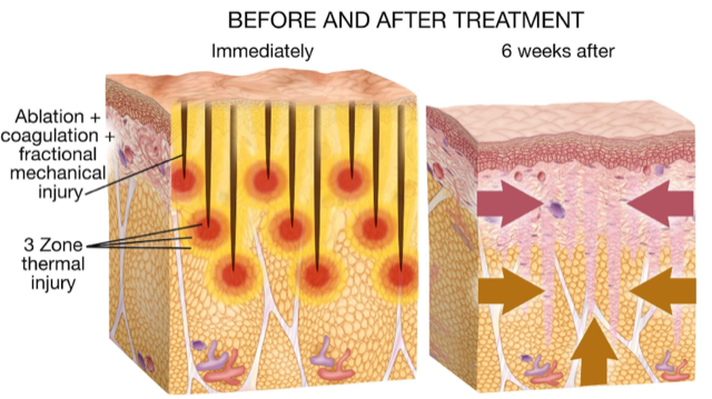 Before and after Morpheus8 treatments - how it works