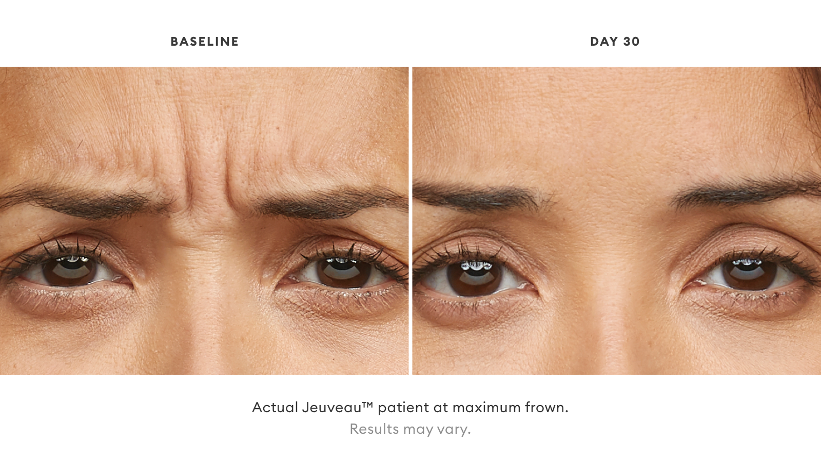 Jeuveau before and after