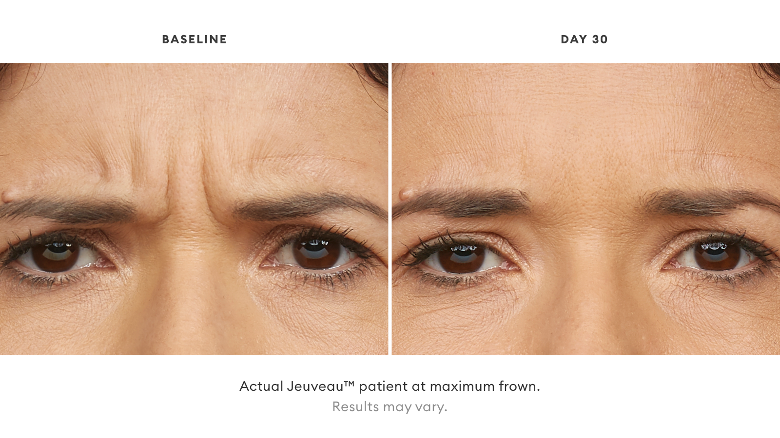 Jeuveau before and after
