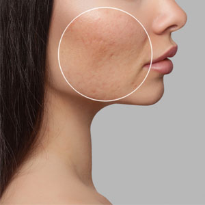 Do You Suffer from Adult Acne and Rosacea? Simi Valley, CA