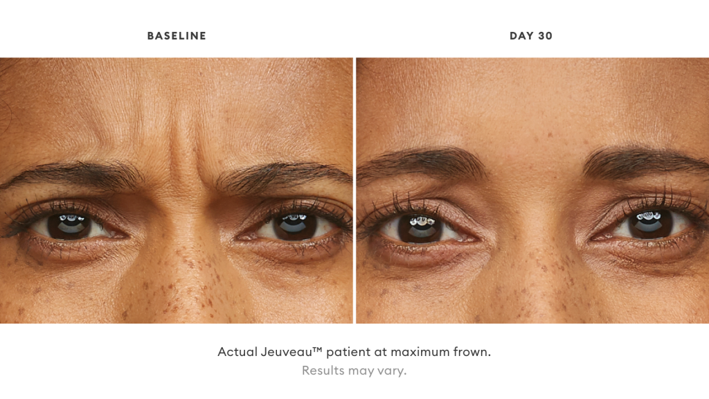 Before and after Jeuveau results