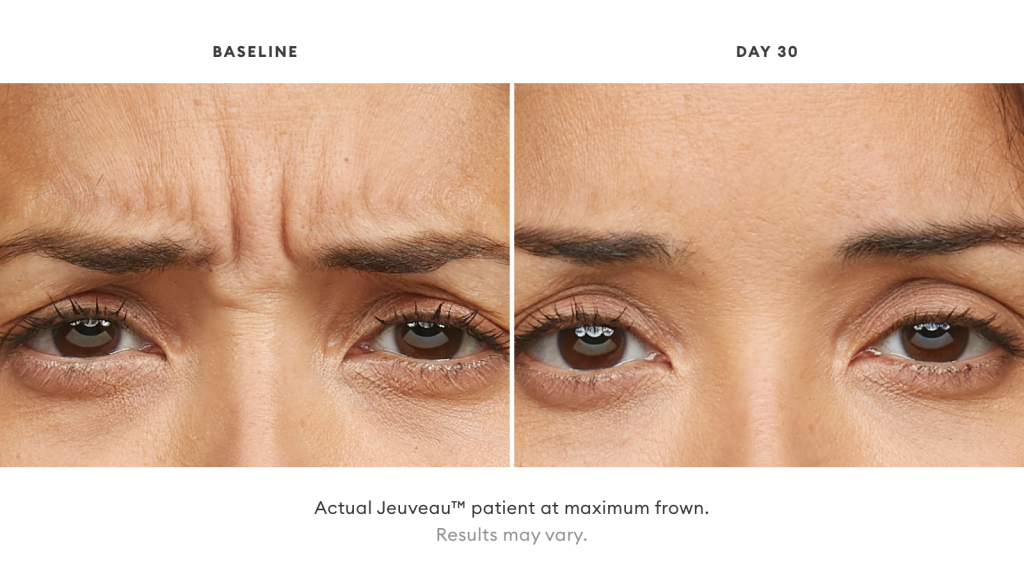 Before and after Jeuveau results