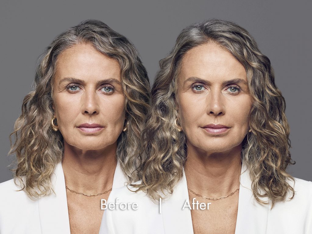 Before and after RHA filler results