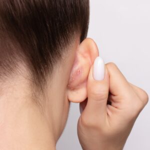 Top 4 Body Areas Where Seborrheic Dermatitis Commonly Appears Simi Valley, CA