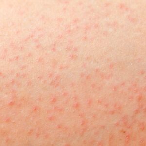 How Can You Tell If Your Razor Bumps Are Actually Bacterial Folliculitis Simi Valley, CA