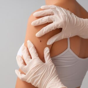 Is Melanoma Rough to the Touch? Simi Valley, CA