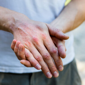 5 Reasons Your Eczema Treatment Isn’t Working and What to Try Instead Simi Valley, CA