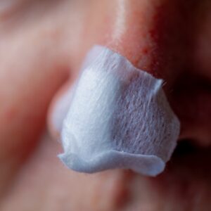 Can You Speed Up Healing After Mohs? Simi Valley, CA